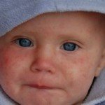 Диагностируем правильно или признаки краснухи