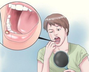 670px-Treat-Canker-Sores-or-Mouth-Ulcers-Step-5-Version-3