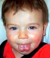 Ankyloglossia_1