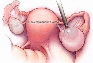 1357473998_endometrioidnaya-kista