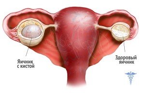 Киста в яичники. Симптомы и последствия