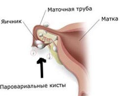 paraovarialnaya-kista-sprava