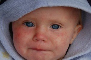 Диагностируем правильно или признаки краснухи